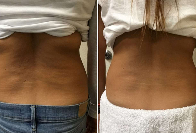 Lipo Cavitation - Renova SPA Temecula