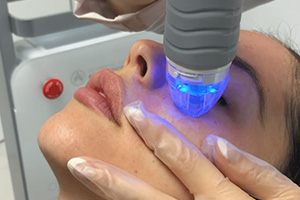 Radiofrequency Microneedling