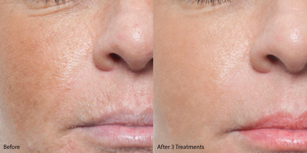 microneedling in Lake Elsinore
