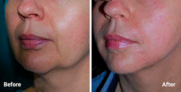microneedling in Lake Elsinore