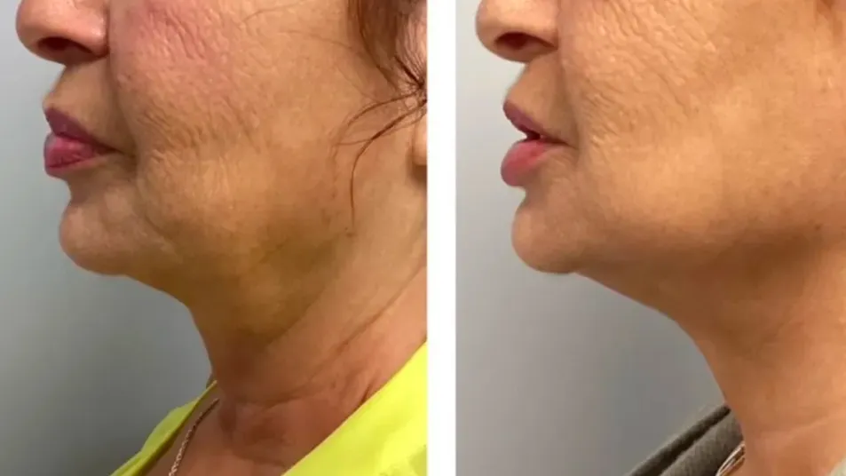 microneedling in Lake Elsinore